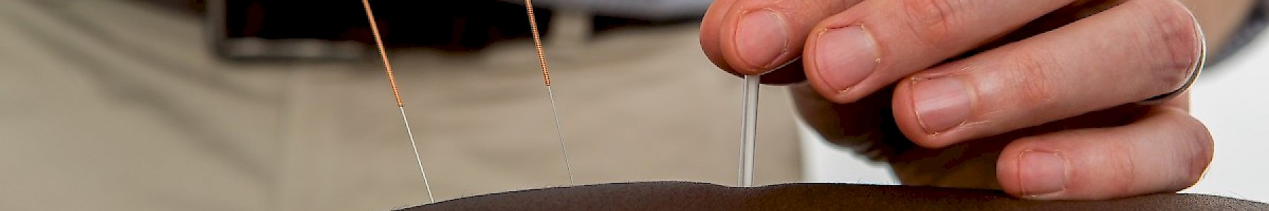 Clapham Osteopath - acupuncture
